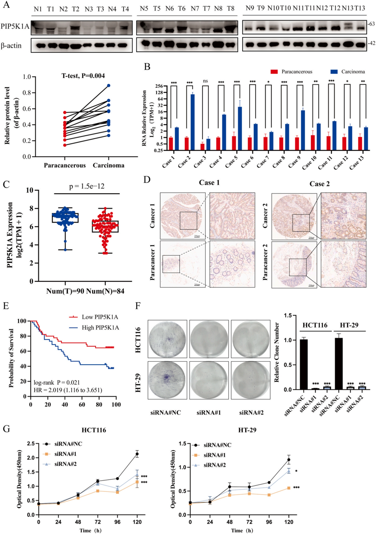 Figure 2- Correlation between abnormal PIP5K1A expression and colorectal cancer progression.png